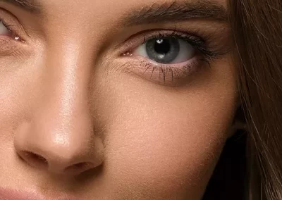 Ácido Hialurónico en Ojeras